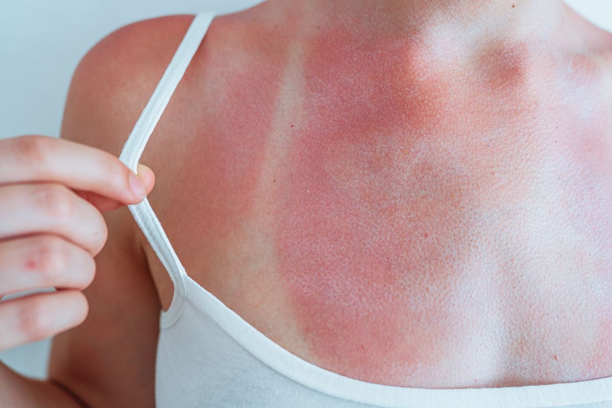 Sonnenbrand im Rems-Murr-Kreis: Schützen, erkennen und richt